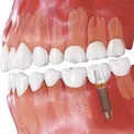 Proteza sau implantare Proteza sau implantare