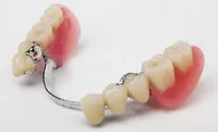 Proteza sau implantare