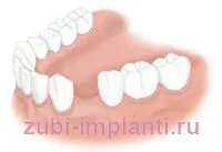 Proteza sau implantare Proteza sau implantare