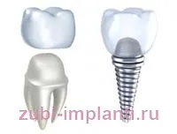 Proteza sau implantare Proteza sau implantare