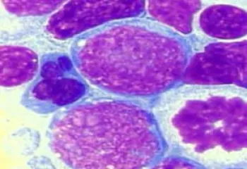 cancer in stadiu terminal