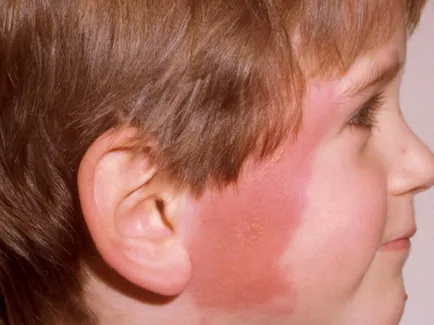 Ce este erizipel inflamație a pielii Ce este erizipel inflamație a pielii