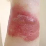 Ce este erizipel inflamație a pielii
