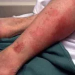 Ce este erizipel inflamație a pielii