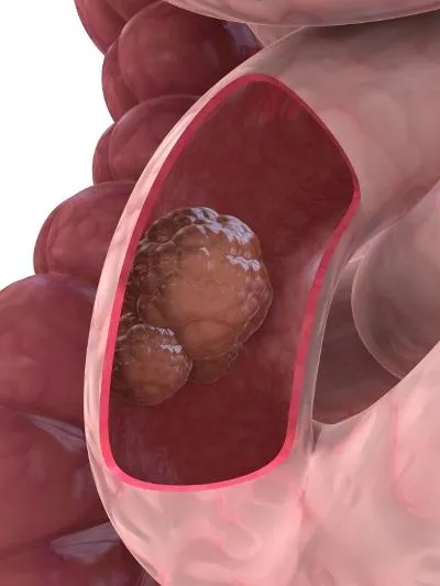 cancer in stadiu terminal