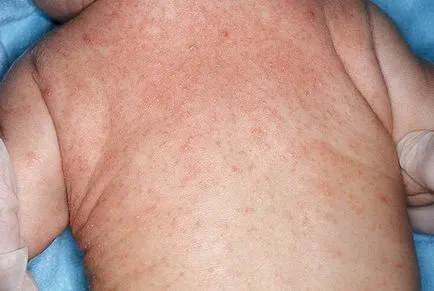 Copilul are o erupție care poate fi Copilul are o erupție care poate fi