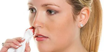 Ce epistaxis carte de vis