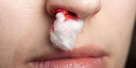 Ce epistaxis carte de vis