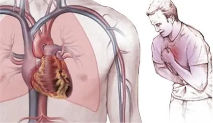 Ce este inima angina