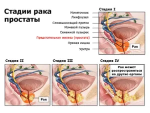 cancer in stadiu terminal
