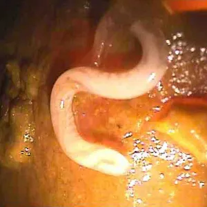 Trichocephalosis-l