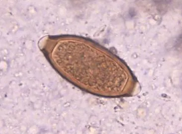 Trichocephalosis-l