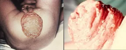 Trichocephalosis-l