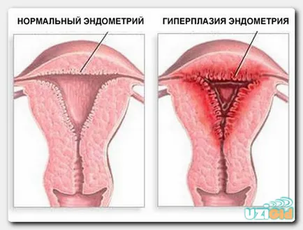 Uzi endometrioza Uzi endometrioza