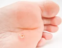 HPV la barbati HPV la barbati