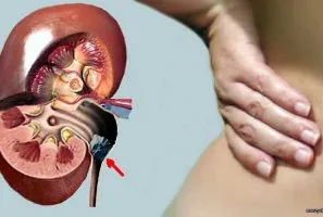 HPV la barbati