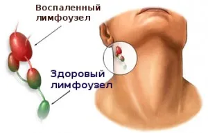 Umflate ganglionilor limfatici îndepărtat