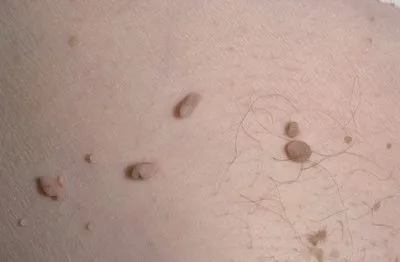 HPV la barbati