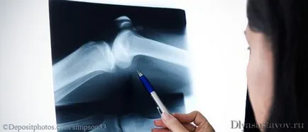 Cum de a restabili cartilajului Cum de a restabili cartilajului
