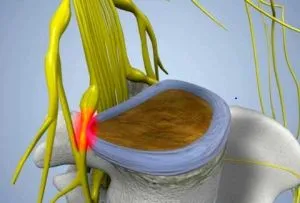 Un tratament nerv sciatic prins