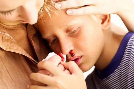 Ce epistaxis carte de vis