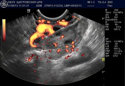 Ce este corpus luteum pe ultrasunete Ce este corpus luteum pe ultrasunete