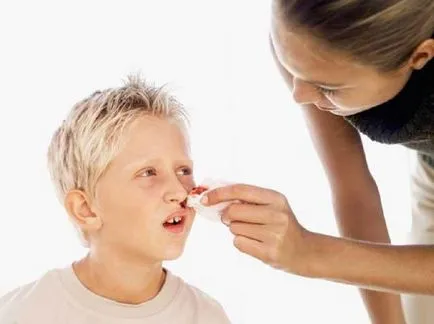 Ce epistaxis carte de vis