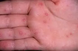 Alergia sub formă de bule, alergii