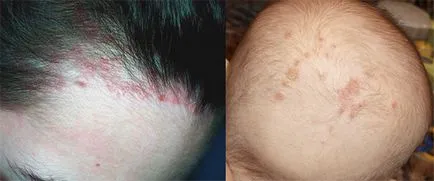 Alergia la cap cauze, simptome, tratament, dieta (simptome) Alergia la cap cauze, simptome, tratament, dieta