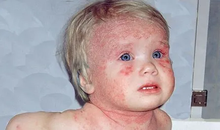 Alergia la cap cauze, simptome, tratament, dieta (cauza) Alergia la cap cauze, simptome, tratament, dieta