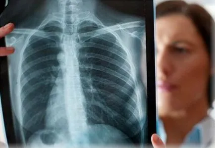 Adenocarcinom a simptomelor pulmonare, stadiul și prognosticul pentru viață