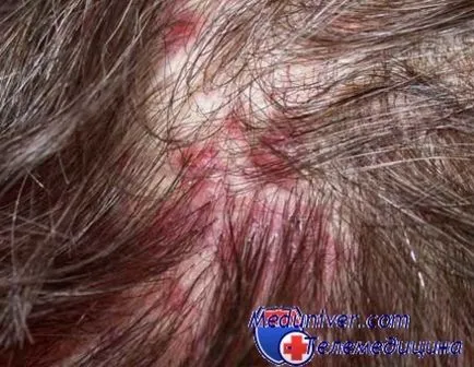Alergia la cap la adulți și copii (alergie) Alergia la cap la adulți și copii