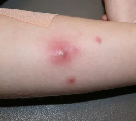 Alergia la îndemână sub formă de bule - tratament și