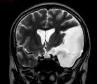 chisturi arachnoida ale creierului - cauze, simptome, diagnostic si tratament (Arachnoid) chisturi arahnoidici ale creierului - cauze, simptome, diagnostic și tratament