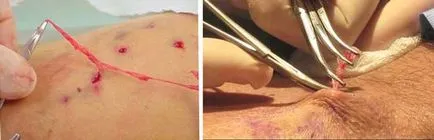 Durere cu varice - cum pentru a calma durerea în venele picioarelor, site-ul medical (venă) Durere cu varice - cum pentru a calma durerea în venele picioarelor, site-ul medical
