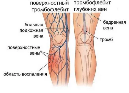 Aching viței la femei, bărbați, motivele pentru care sunt bolnavi decât pentru a trata