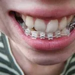 Bretele sunt răspunsurile la întrebări frecvente, povești de oameni reali (populare) Bretele sunt răspunsurile la întrebări frecvente, povești de oameni reali