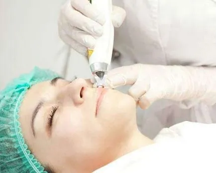 buzele cu botox sunt procedurile, consecințele