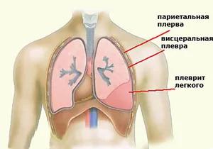 Ce este - straturi pleurale cu raze X in plamani, si se pare ca un plămân sănătos (pleural) Ce este - straturi pleurale cu raze X in plamani, si se pare ca un plămân sănătos