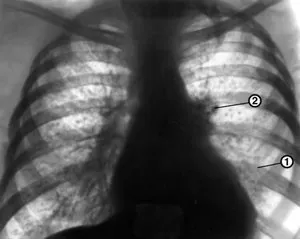 Ce este - straturi pleurale cu raze X in plamani, si se pare ca un plămân sănătos (rădăcini de consolidare pulmonară) Ce este - straturi pleurale cu raze X in plamani, si se pare ca un plămân sănătos