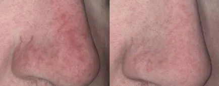 Ceea ce face laser resurfacing a feței, opinii și comentarii cu privire la procedura (cu laser resurfacing fotografiile de cicatrici înainte și după) Ceea ce face laser resurfacing a feței, opinii și comentarii cu privire la procedura
