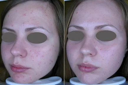 Ceea ce face laser resurfacing a feței, opinii și comentarii cu privire la procedura (contraindicații cu laser resurfacing) Ceea ce face laser resurfacing a feței, opinii și comentarii cu privire la procedura