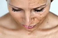 Ce este o enzimă peeling și cum funcționează