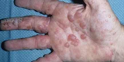 Dyshydrosis mâini - unguente tratament la domiciliu si dieta (perii) mâini Dyshydrosis - unguente tratament la domiciliu și dieta