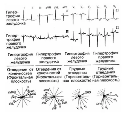 Fireaid electrocardiografe - ECG (patologie atrială (p) și ventriculare (QRS, st) (p) Fireaid electrocardiografe - ECG (patologie atrială (p) și ventriculare (QRS, st)