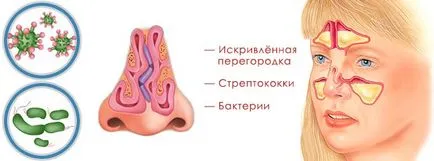 simptome Sinuzita la adulți și tratamentul primelor semne și simptome (pentru adulți) simptome Sinuzita la adulți și tratamentul primelor semne și simptome