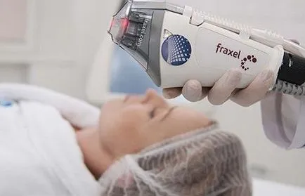 Fraxel - ce este, cum să treacă, de reabilitare, recenzii și fotografii (realiza schimbări pozitive) Fraxel - ce este, cum să treacă, reabilitarea, recenzii și fotografii