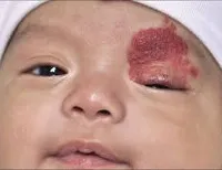 Hemangiom la copii - cauze, simptome, diagnostic si tratament (hemangiom) Hemangiom la copii - cauze, simptome, diagnostic și tratament