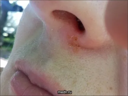 Tratamentul Herpes de remedii populare (virusul herpes simplex) remedii populare de tratament Herpes