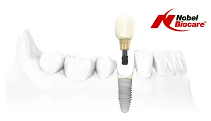 Implanturile dentare au rang mai bine clinici